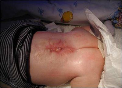 infection3.jpg