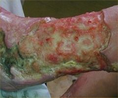 infection5.jpg