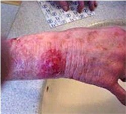 infection7.jpg