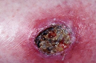 infection12.jpg
