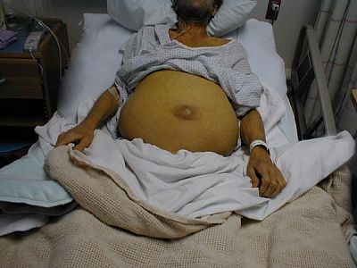 abdomen_ascites.jpg