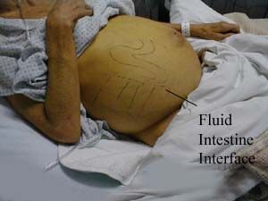 Name:  abdomen_ascites2.jpg
Views: 3221
Size:  31.0 KB