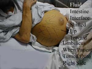 Name:  abdomen_ascites3.jpg
Views: 3407
Size:  35.9 KB
