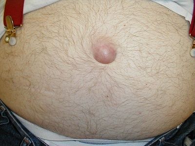 abdomen_incarcerated_umbo.jpg