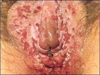 genital-warts-female070909.jpg