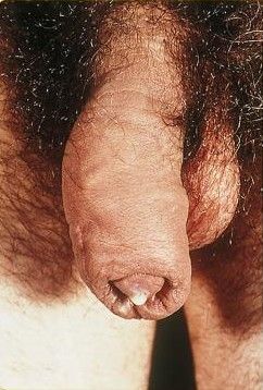 gonorrhea-wikipedia.jpg