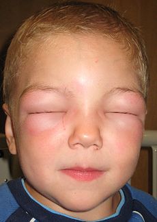 230px-Angioedema2010.JPG