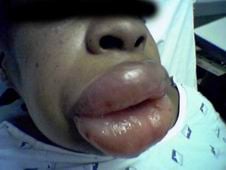 angioedema.jpg
