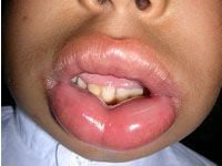 angioedema1-s.jpg