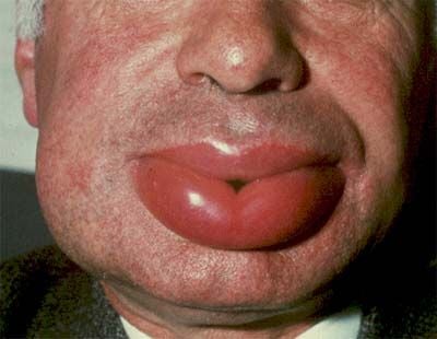 hereditary_angioedema.jpg