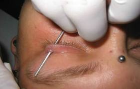 eyelid2.jpg