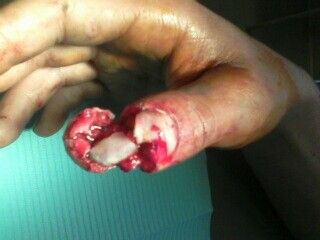 Jere's Thumb.jpg