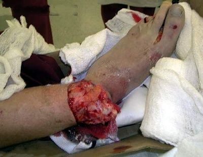 fracture.jpg