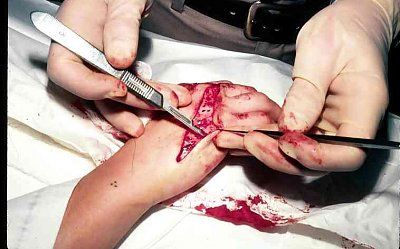 deep-hand-wound.jpg