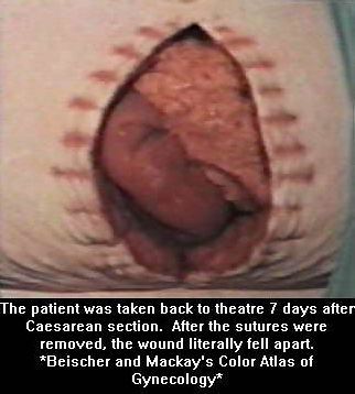 burst-c-section.jpg