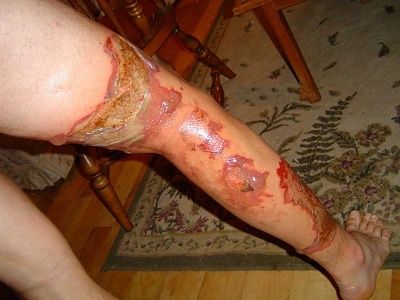 burned1.jpg