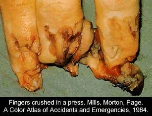 fingers crushed.PNG