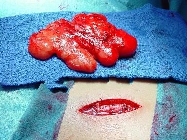 tumor1.jpg