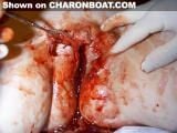 tn_charonboat_dot_com_female_circumcision6.jpg