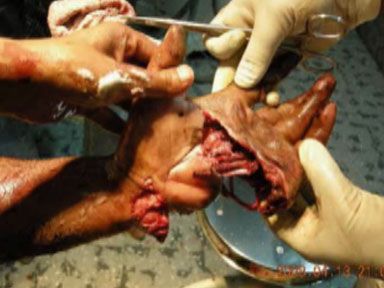 crushed-hand-bindeswari-1.jpg