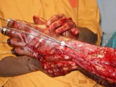 crushed-hand-bindeswari-2.jpg