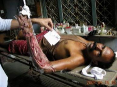 crushed-hand-bindeswari-3.jpg