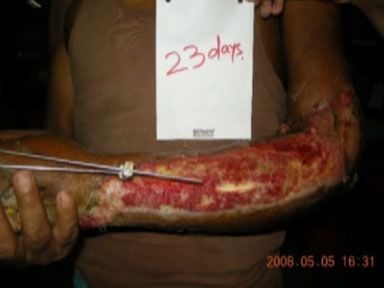 crushed-hand-bindeswari-5.jpg