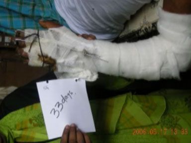crushed-hand-bindeswari-7.jpg