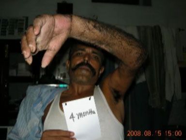 crushed-hand-bindeswari-8.jpg
