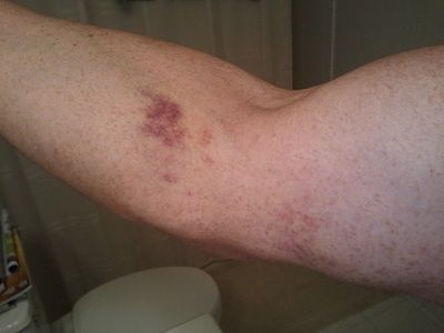 bicep-tear.jpg