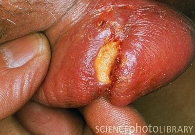 m8620053-syphilis_chancre_on_penis-spl.jpg