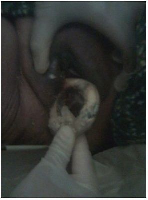 pessary-fig1.jpg