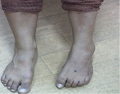 dermoid-fig1.jpg