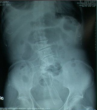 Name:  dermoid-fig3.jpg
Views: 1826
Size:  15.6 KB