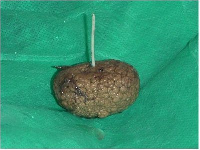 bladder-stone.jpg