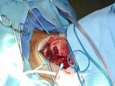 knee-surgery.jpg