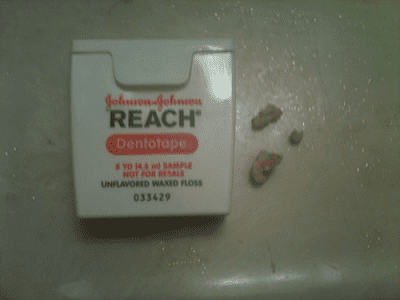 tonsil-stones.png