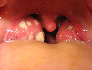 how-to-get-rid-of-tonsil-stones.jpg
