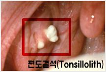 tonsillolith.jpg