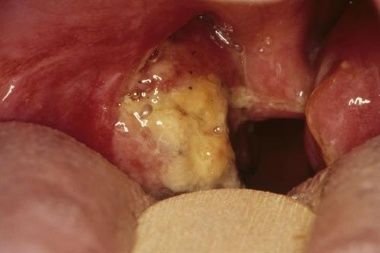 Tonsil-Stones.jpg