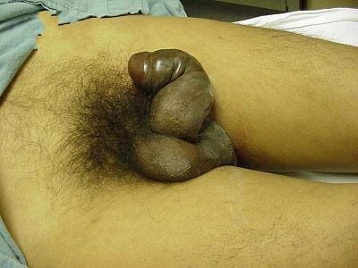 fractured-penis.jpg