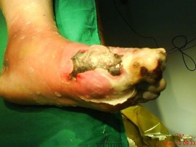 gangrene-feet-2-.jpg