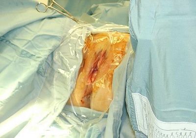 hysterectomy-1-.jpg
