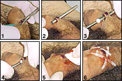 Genital_Beading-5.jpg