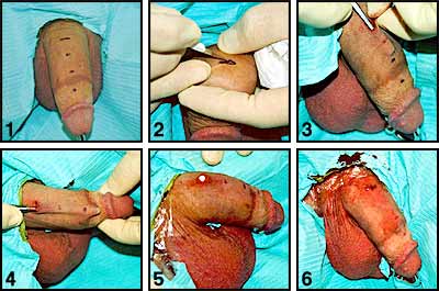 Genital_Beading-6.jpg