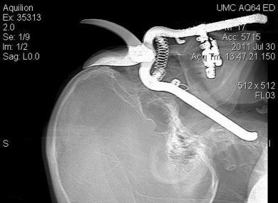 Shears-in-Eye-Socket_Free-390x285.jpg