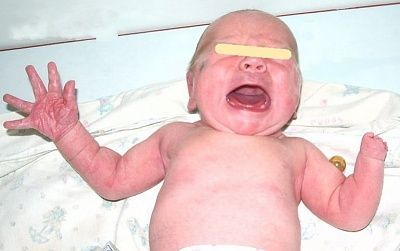 baby-born-deformed-hand-1-.jpg