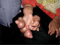 3-Deformed-Hand.jpg