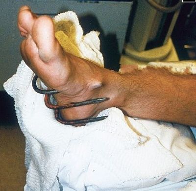 impaled-foot.jpg