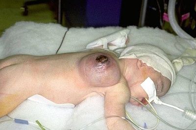 tumour.jpg